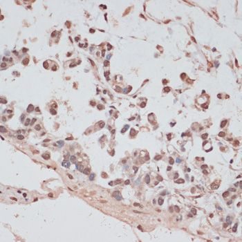 Immunohistochemistry of paraffin-embedded Human gastric cancer using PRPF31 Polyclonal Antibody at dilution of  1:100 (40x lens).