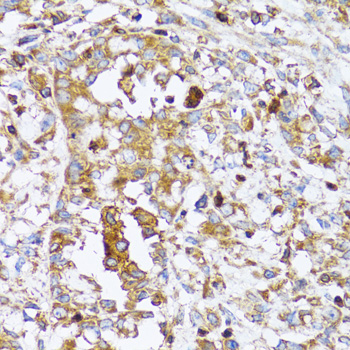 Immunohistochemistry of paraffin-embedded Human uterine cancer using ACTR2 Polyclonal Antibody at dilution of  1:100 (40x lens).