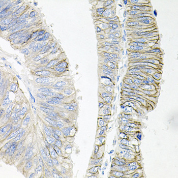 Immunohistochemistry of paraffin-embedded Human colon carcinoma using ATP1B1 Polyclonal Antibody at dilution of  1:100 (40x lens).