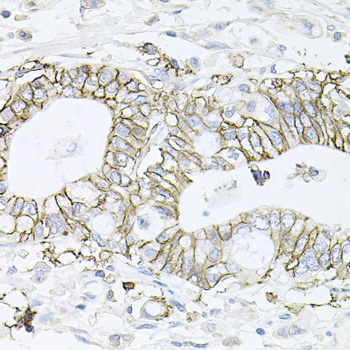 Immunohistochemistry of paraffin-embedded Human gastric cancer using ATP1B1 Polyclonal Antibody at dilution of  1:100 (40x lens).