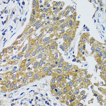 Immunohistochemistry of paraffin-embedded Human lung cancer using GOT1 Polyclonal Antibody at dilution of  1:100 (40x lens).