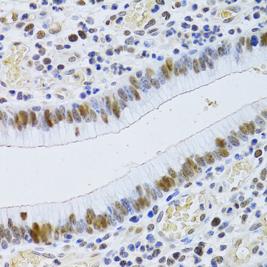 Immunohistochemistry of paraffin-embedded Human gastric cancer using JMJD6 Polyclonal Antibody at dilution of  1:100 (40x lens).