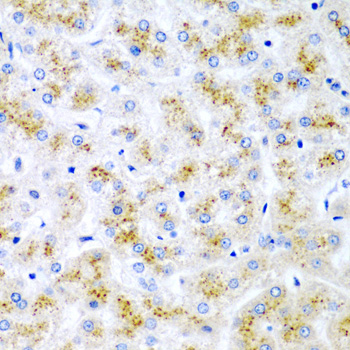 Immunohistochemistry of paraffin-embedded Human liver damage using WNT2 Polyclonal Antibody at dilution of  1:200 (40x lens).