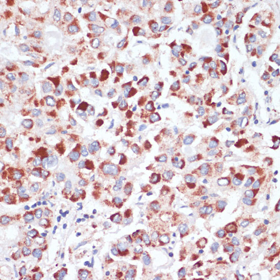 Immunohistochemistry of paraffin-embedded Human liver cancer using TFRC Polyclonal Antibody at dilution of  1:100 (40x lens).