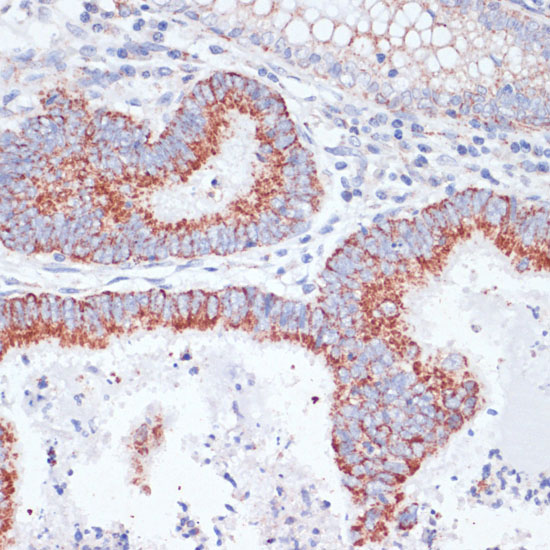 Immunohistochemistry of paraffin-embedded Human colon carcinoma using TFRC Polyclonal Antibody at dilution of  1:100 (40x lens).
