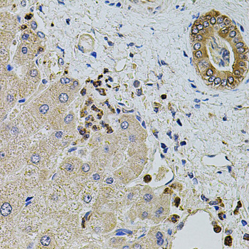 Immunohistochemistry of paraffin-embedded Human liver damage using KTN1 Polyclonal Antibody at dilution of  1:100 (40x lens).