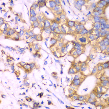 Immunohistochemistry of paraffin-embedded Human liver cancer using RPS3A Polyclonal Antibody at dilution of  1:100 (40x lens).