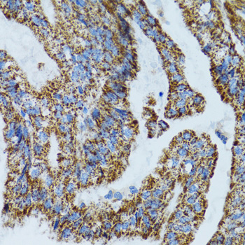 Immunohistochemistry of paraffin-embedded Human gastric cancer using MRPL28 Polyclonal Antibody at dilution of  1:100 (40x lens).