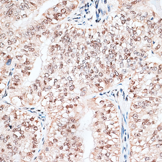 Immunohistochemistry of paraffin-embedded Human endometrium cancer using RBM3 Polyclonal Antibody at dilution of  1:100 (40x lens).