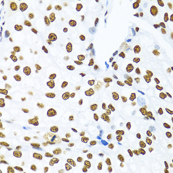 Immunohistochemistry of paraffin-embedded Human prostate cancer using KHDRBS1 Polyclonal Antibody at dilution of  1:100 (40x lens).