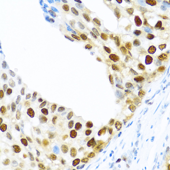 Immunohistochemistry of paraffin-embedded Human prostate cancer using KHDRBS2 Polyclonal Antibody at dilution of  1:100 (40x lens).