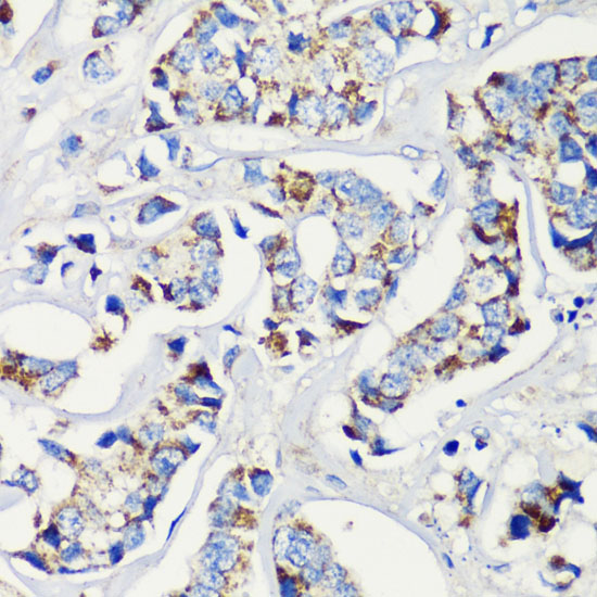 Immunohistochemistry of paraffin-embedded Human breast cancer using KMT2E Polyclonal Antibody at dilution of  1:200 (40x lens).