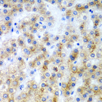 Immunohistochemistry of paraffin-embedded Human liver cancer using LY86 Polyclonal Antibody at dilution of  1:200 (40x lens).