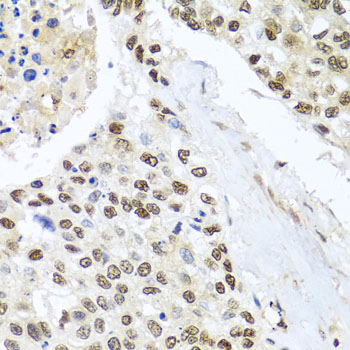 Immunohistochemistry of paraffin-embedded Human lung cancer using BNIP3L Polyclonal Antibody at dilution of  1:100 (40x lens).