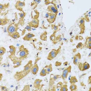 Immunohistochemistry of paraffin-embedded Human liver cancer using BTD Polyclonal Antibody at dilution of  1:100 (40x lens).