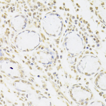 Immunohistochemistry of paraffin-embedded Human gastric cancer using SNRPA Polyclonal Antibody at dilution of  1:100 (40x lens).