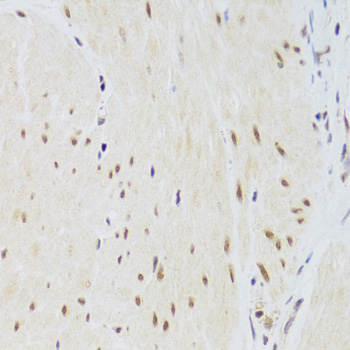 Immunohistochemistry of paraffin-embedded Human gastric cancer using CSRP3 Polyclonal Antibody at dilution of  1:100 (40x lens).