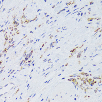 Immunohistochemistry of paraffin-embedded Human gastric cancer using GATM Polyclonal Antibody at dilution of  1:100 (40x lens).