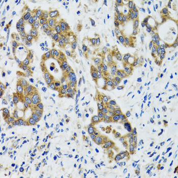 Immunohistochemistry of paraffin-embedded Human colon carcinoma using HYOU1 Polyclonal Antibody at dilution of  1:100 (40x lens).