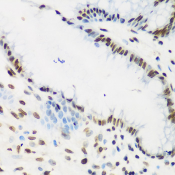 Immunohistochemistry of paraffin-embedded Human stomach cancer using KLF4 Polyclonal Antibody at dilution of  1:200 (40x lens).