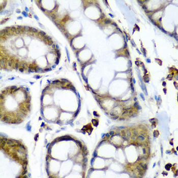 Immunohistochemistry of paraffin-embedded Human colon carcinoma using SECISBP2 Polyclonal Antibody at dilution of  1:200 (40x lens).