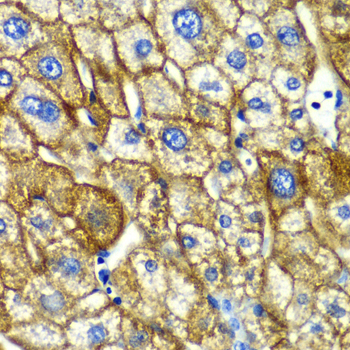 Immunohistochemistry of paraffin-embedded Human liver damage using ASGR1 Polyclonal Antibody at dilution of  1:100 (40x lens).