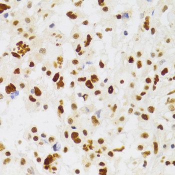 Immunohistochemistry of paraffin-embedded Human brain astrocytoma using NASP Polyclonal Antibody at dilution of  1:100 (40x lens).