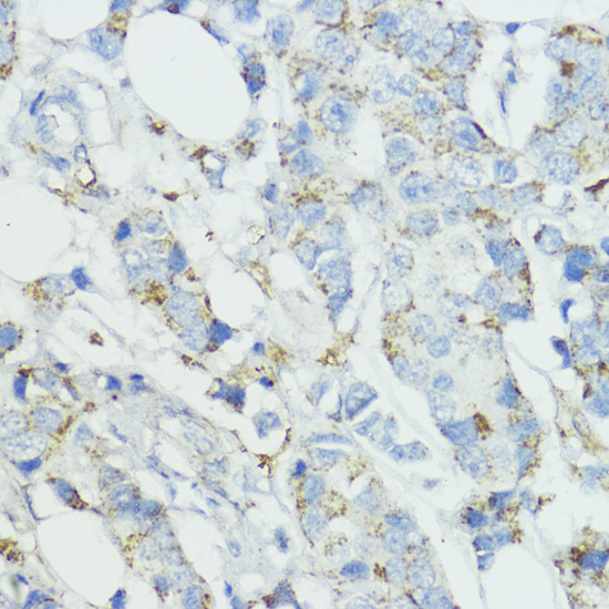 Immunohistochemistry of paraffin-embedded Human mammary cancer using SOD3 Polyclonal Antibody at dilution of  1:100 (40x lens).