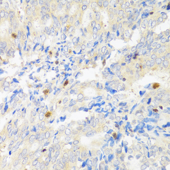 Immunohistochemistry of paraffin-embedded Human rectal cancer using STAT4 Polyclonal Antibody at dilution of  1:100 (40x lens).