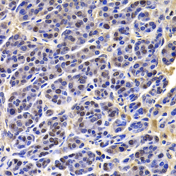 Immunohistochemistry of paraffin-embedded Human liver cancer using HIRIP3 Polyclonal Antibody at dilution of  1:100 (40x lens).
