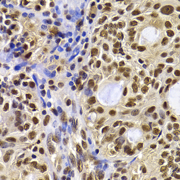 Immunohistochemistry of paraffin-embedded Human oophoroma using HIRIP3 Polyclonal Antibody at dilution of  1:100 (40x lens).