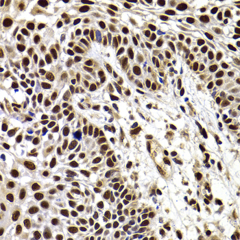 Immunohistochemistry of paraffin-embedded Human well-differentiated squamous skin carcinoma using HIRIP3 Polyclonal Antibody at dilution of  1:100 (40x lens).