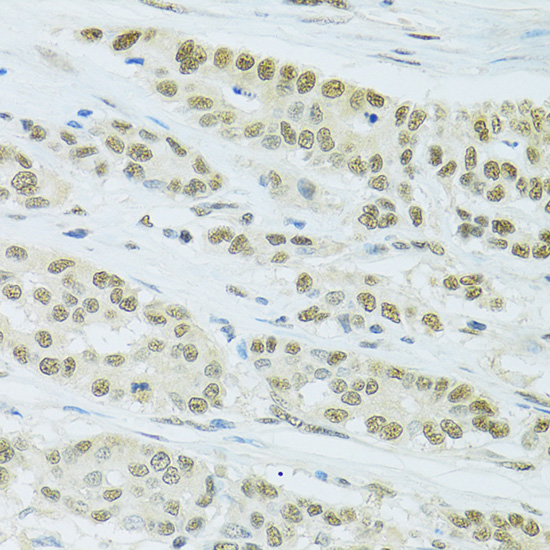 Immunohistochemistry of paraffin-embedded Human colon carcinoma using FIP1L1 Polyclonal Antibody at dilution of  1:100 (40x lens).