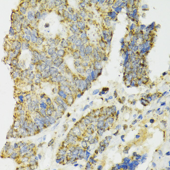 Immunohistochemistry of paraffin-embedded Human colon carcinoma using IDH2 Polyclonal Antibody at dilution of  1:100 (40x lens).