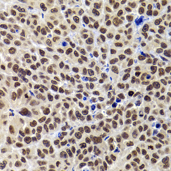 Immunohistochemistry of paraffin-embedded Mouse tumor using PHIP Polyclonal Antibody at dilution of  1:100 (40x lens).