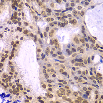 Immunohistochemistry of paraffin-embedded Human oophoroma using POLD3 Polyclonal Antibody at dilution of  1:100 (40x lens).