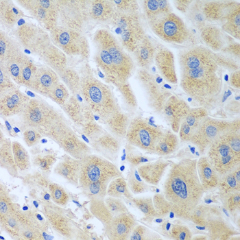 Immunohistochemistry of paraffin-embedded Human liver cancer using BLVRB Polyclonal Antibody at dilution of  1:100 (40x lens).