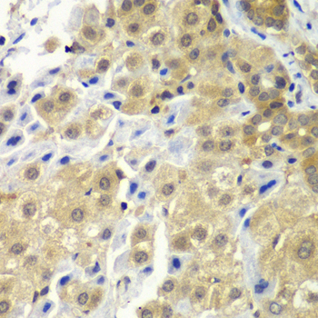 Immunohistochemistry of paraffin-embedded Human liver cancer using SGTA Polyclonal Antibody at dilution of  1:100 (40x lens).