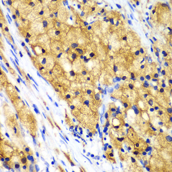 Immunohistochemistry of paraffin-embedded Human lung cancer using CAPG Polyclonal Antibody at dilution of  1:100 (40x lens).