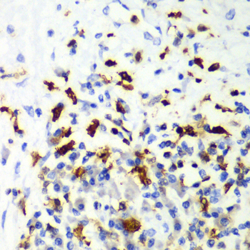 Immunohistochemistry of paraffin-embedded Human liver cancer using CAPG Polyclonal Antibody at dilution of  1:100 (40x lens).