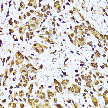 Immunohistochemistry of paraffin-embedded Human gastric cancer using KU70 Polyclonal Antibody at dilution of  1:100 (40x lens).