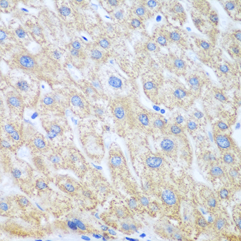 Immunohistochemistry of paraffin-embedded Human liver cancer using PTGS1 Polyclonal Antibody at dilution of  1:100 (40x lens).