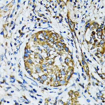 Immunohistochemistry of paraffin-embedded Human lung cancer using ATG7 Polyclonal Antibody at dilution of  1:100 (40x lens).