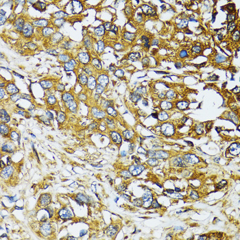 Immunohistochemistry of paraffin-embedded Human liver cancer using ATG7 Polyclonal Antibody at dilution of  1:100 (40x lens).