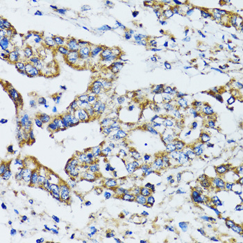 Immunohistochemistry of paraffin-embedded Human colon carcinoma using ATG7 Polyclonal Antibody at dilution of  1:100 (40x lens).