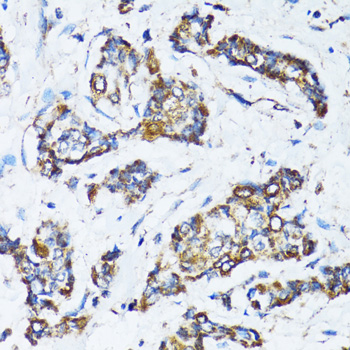 Immunohistochemistry of paraffin-embedded Human breast cancer using ATG7 Polyclonal Antibody at dilution of  1:100 (40x lens).