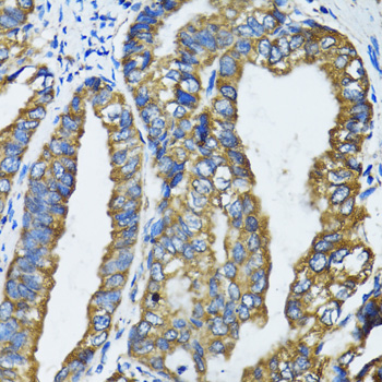 Immunohistochemistry of paraffin-embedded Human gastric cancer using ATG7 Polyclonal Antibody at dilution of  1:100 (40x lens).