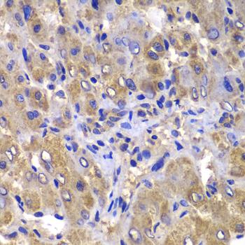 Immunohistochemistry of paraffin-embedded Human liver damage using CARD10 Polyclonal Antibody at dilution of  1:100 (40x lens).