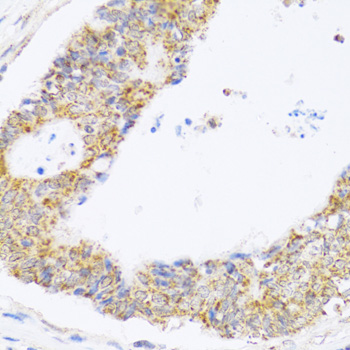 Immunohistochemistry of paraffin-embedded Human colon carcinoma using ZAK Polyclonal Antibody at dilution of  1:100 (40x lens).