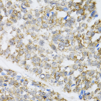 Immunohistochemistry of paraffin-embedded Human esophageal cancer using ZAK Polyclonal Antibody at dilution of  1:100 (40x lens).